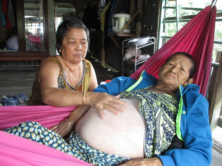 Giúp bà Xa trị bệnh xơ gan
